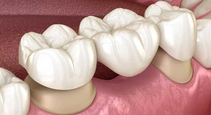 بریج های دندانی