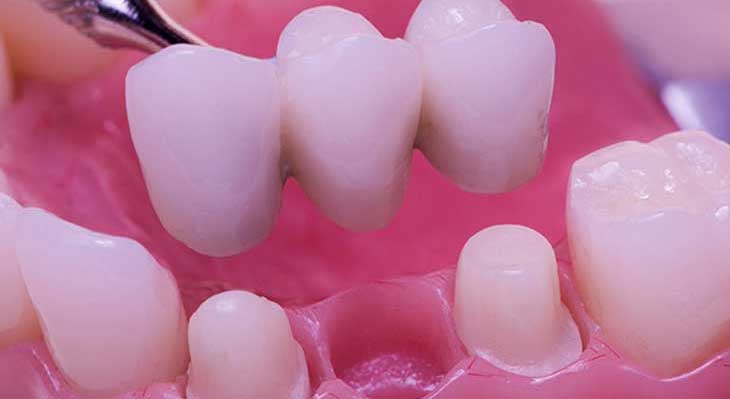 بریج های دندانی