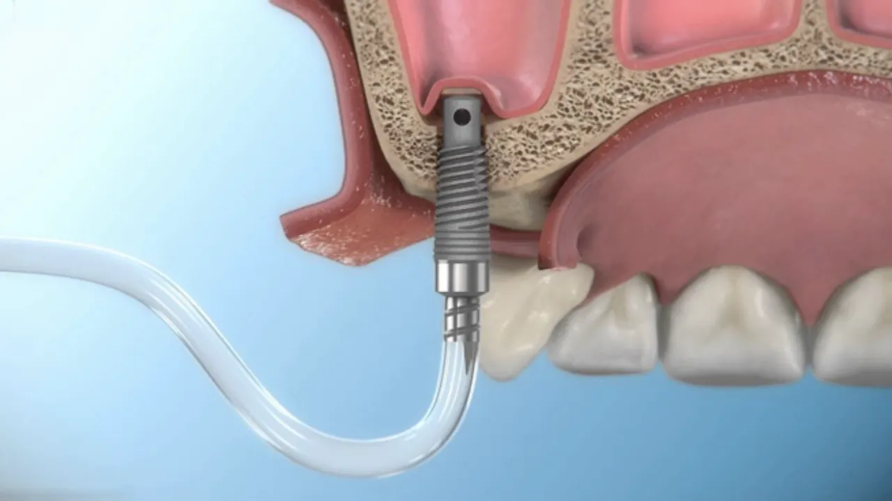 جراحی لیفت سینوس در ایمپلنت