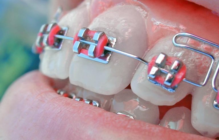 مراقبت های بعد از ارتودنسی دندان