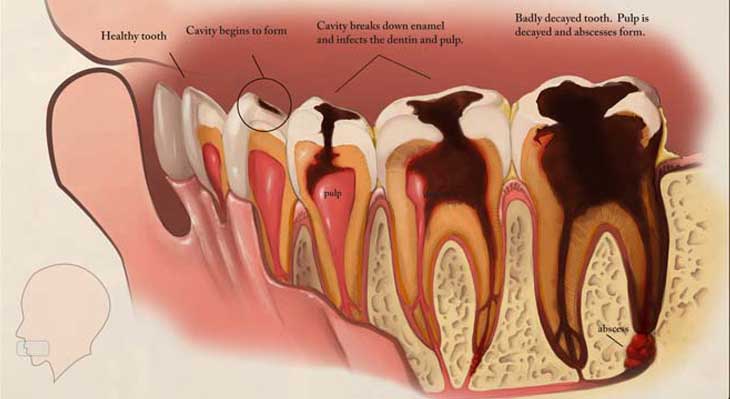 علت سیاه شدن دندان