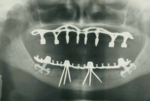 تاریخ ایمپلنت دندان