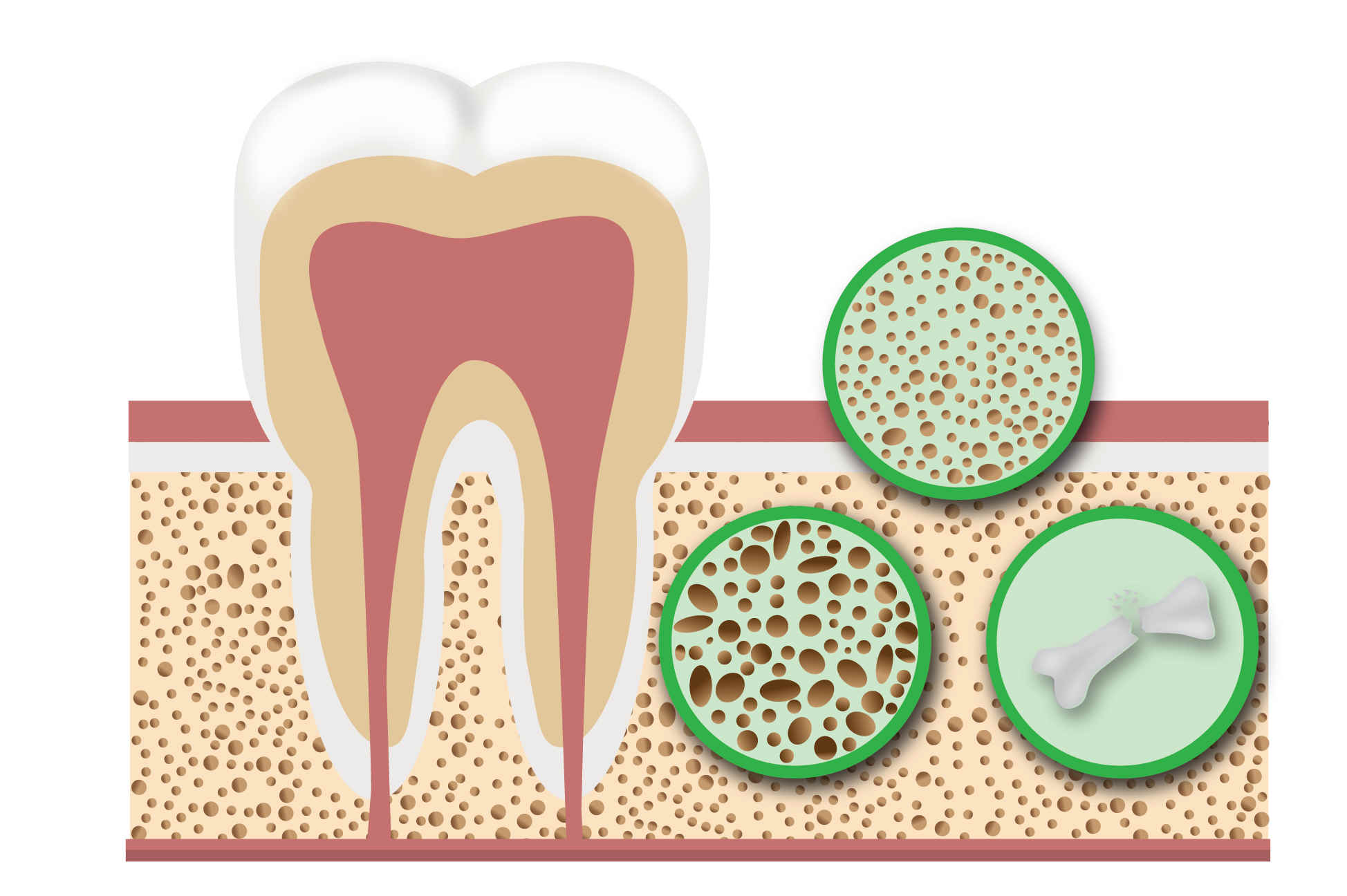 پوکی استخوان و سلامت دندان