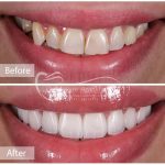 كامپوزيت ونير دندانهاى فك بالا با تكنيك ليرينگ