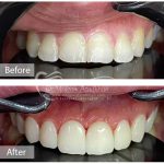 كامپوزيت ونير دندانهاى فك بالا با كامپوزيت توكوياما