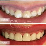 كامپوزيت ونير دندانهاى فك بالا با كامپوزيت توكوياما