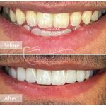 كامپوزيت ونير دندانهاى فک بالا و پايين با كامپوزيت آى پى اس