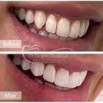 ونیر کامپوزیتی فک بالا