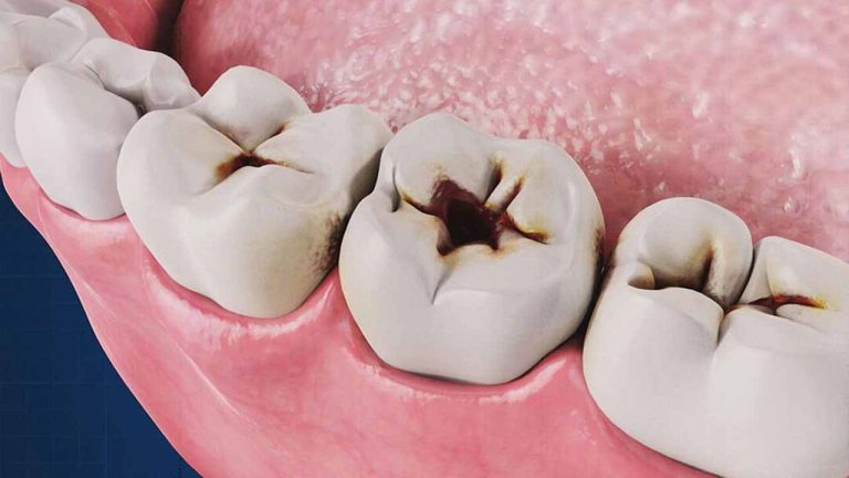 پوسیدگی بین دندان