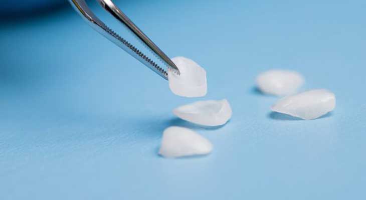 انواع ونیر دندان