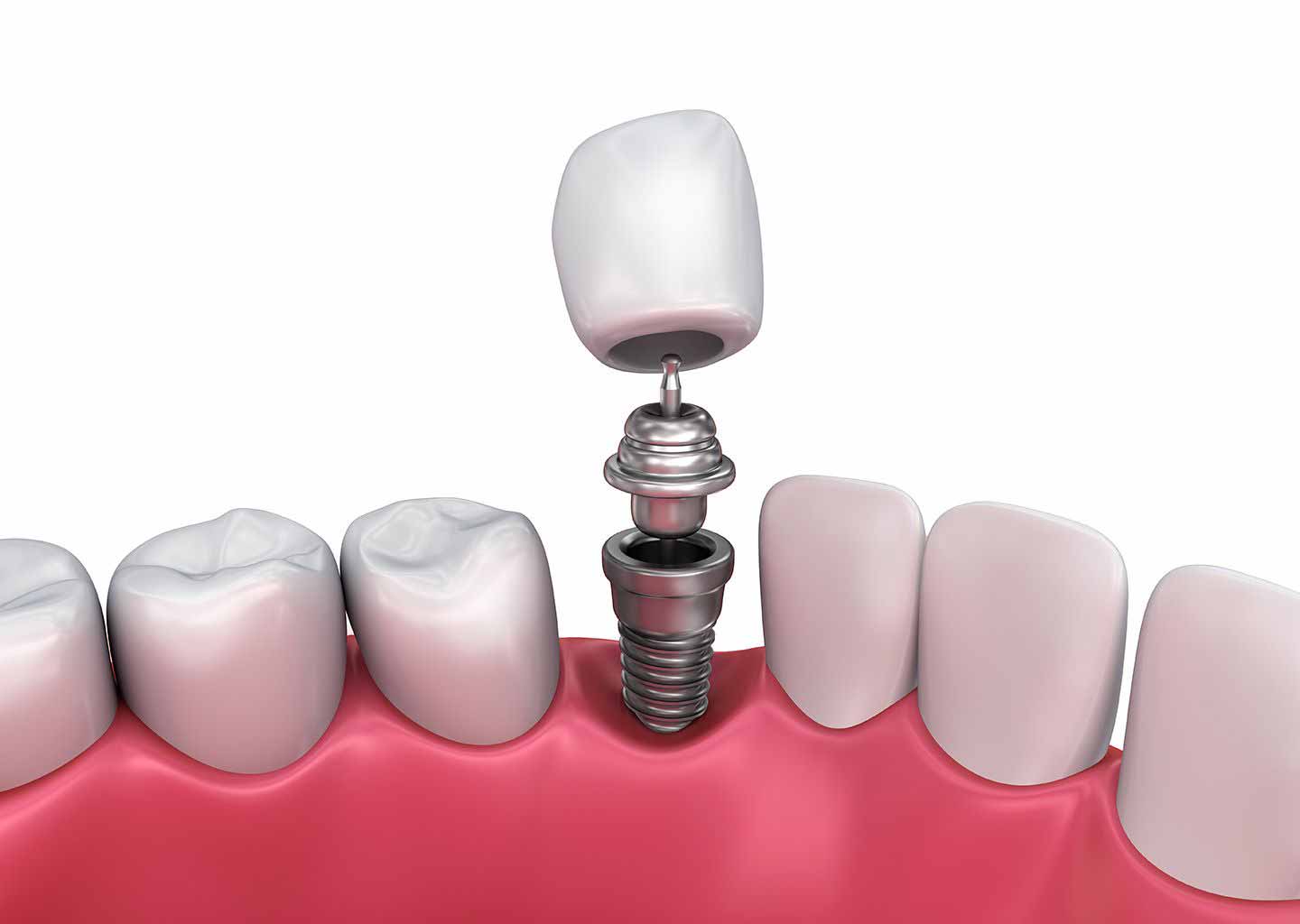 ایمپلنت دندان