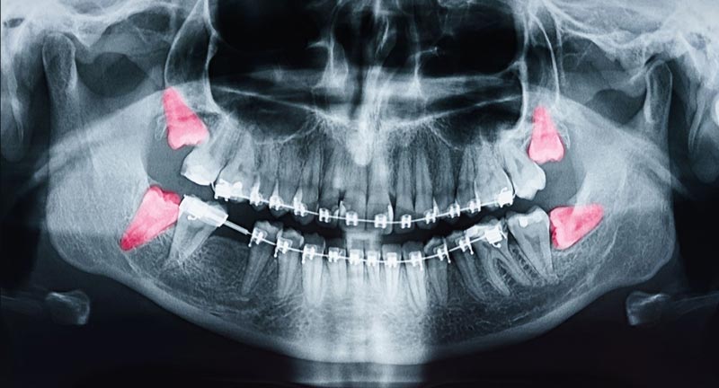 درمان درد دندان عقل