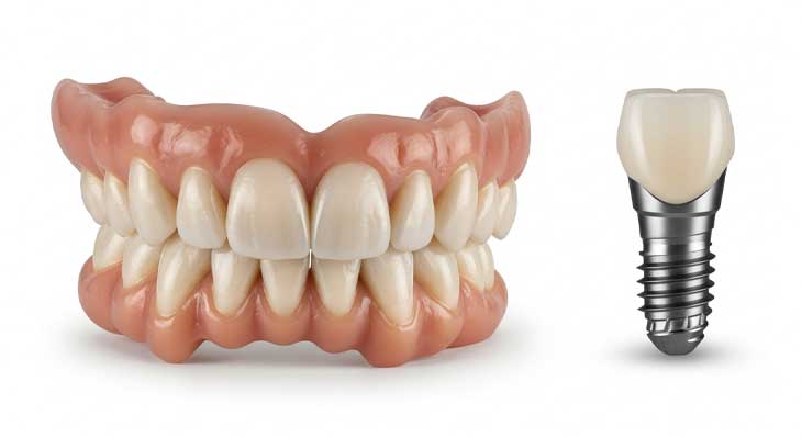 فرق اوردنچر با ایمپلنت