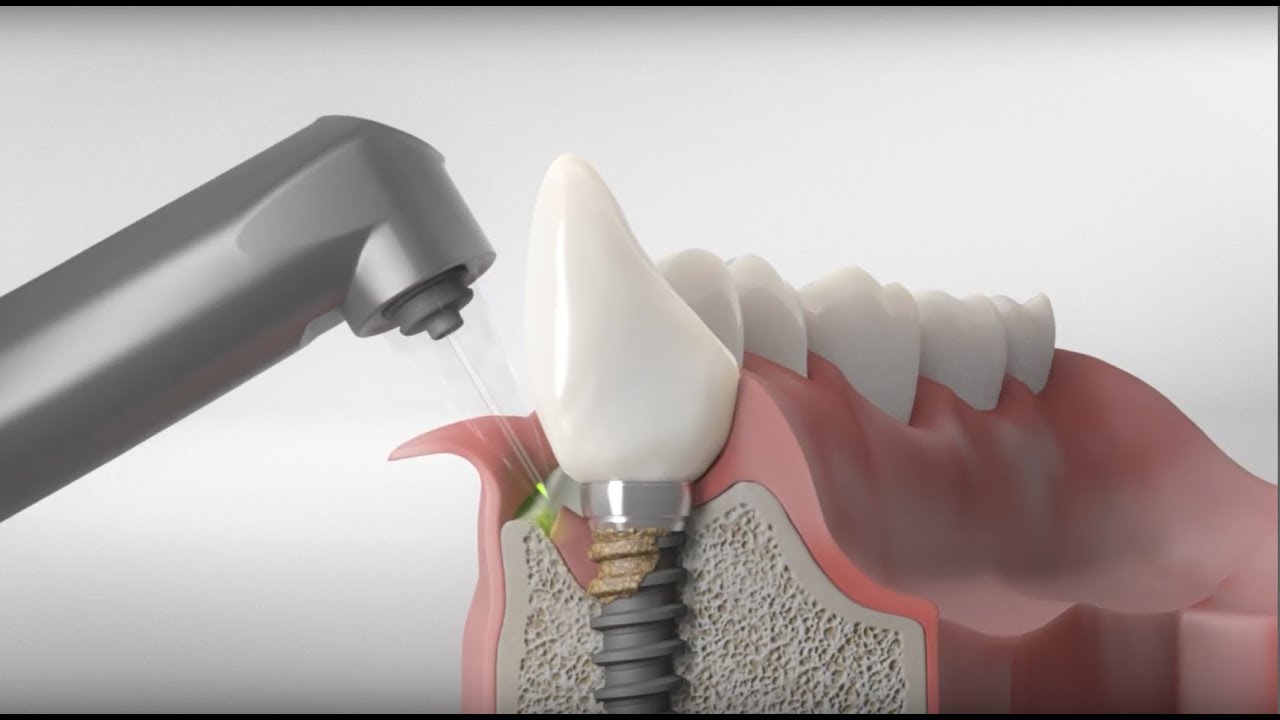 ایمپلنت دندان با لیزر