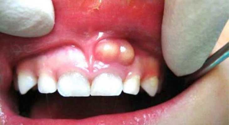 عفونت دندان