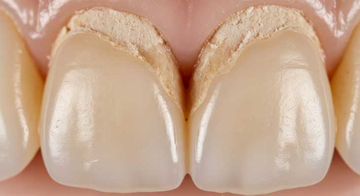 از بین رفتن مینای دندان