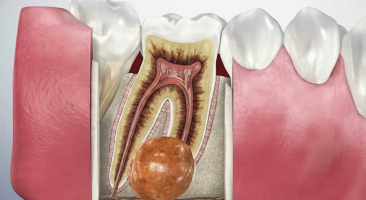 عفونت دندان