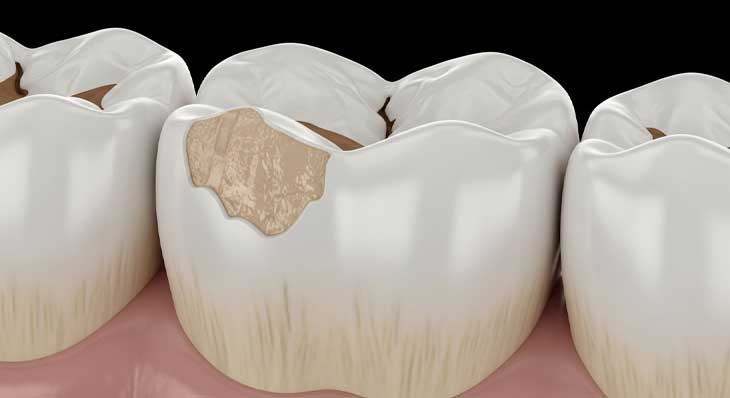 از بین رفتن مینای دندان