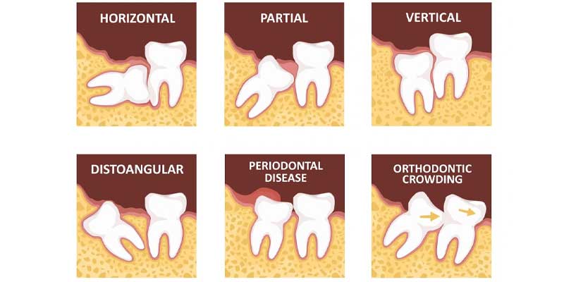 انواع دندان عقل