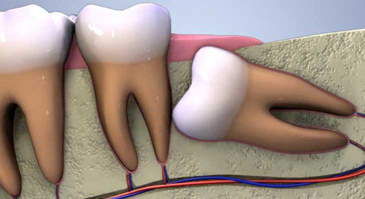 عصب کشی دندان عقل
