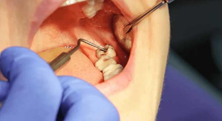 عصب کشی دندان عقل