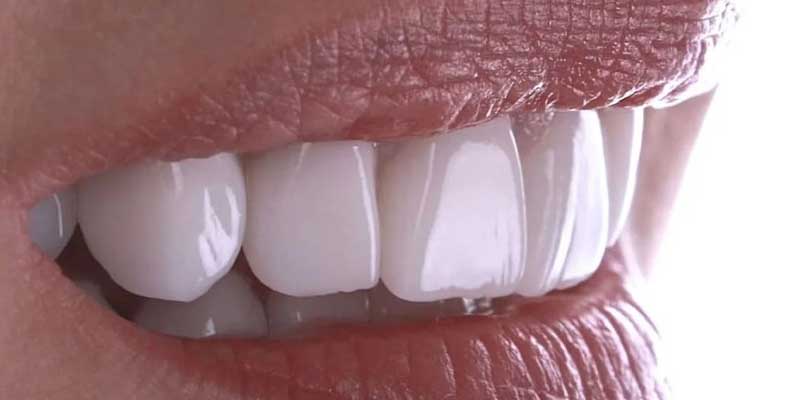 لمینت سرامیکی ایمکس EMAX