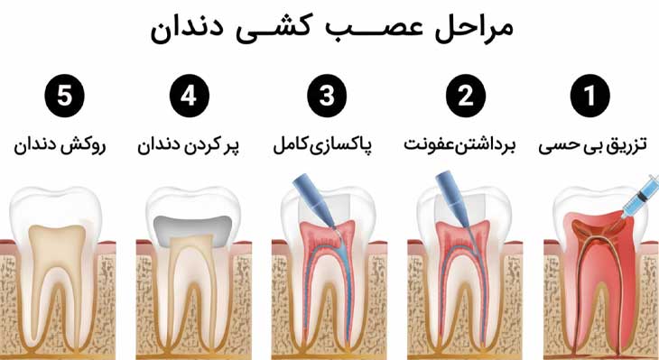 عصب کشی دندان