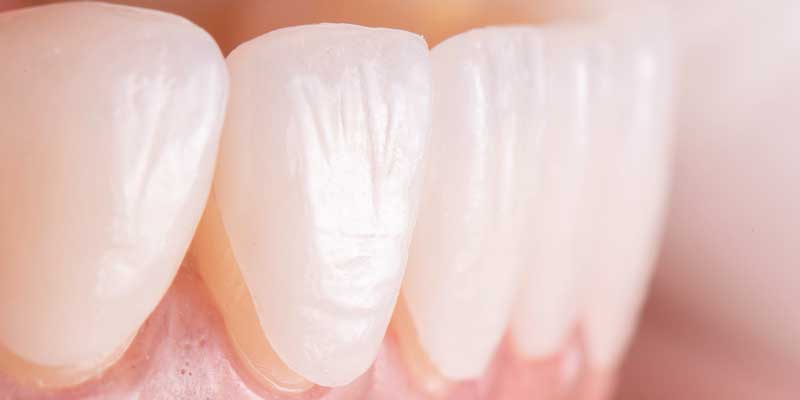 لمینت سرامیکی ایمکس EMAX