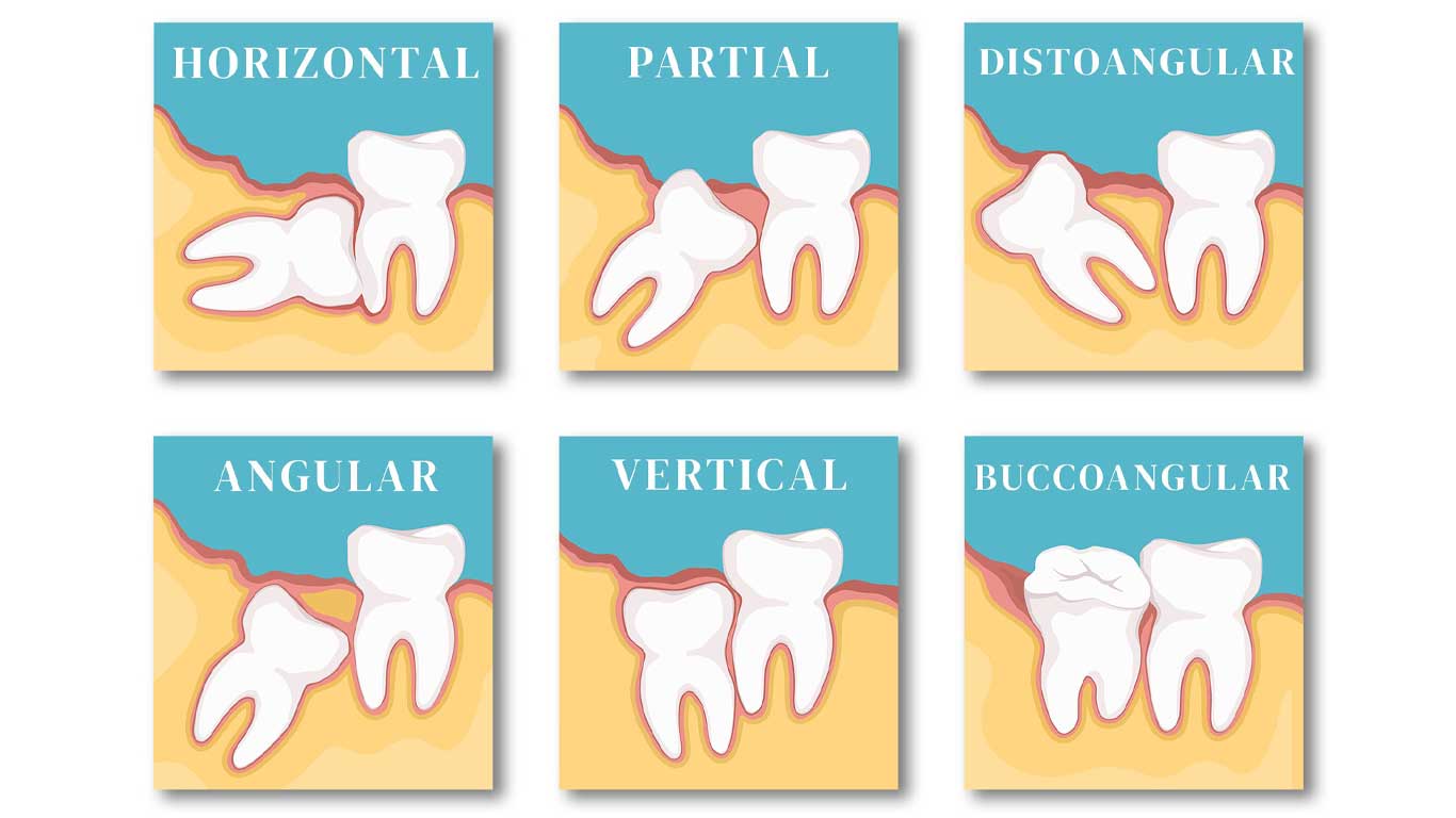 انواع دندان عقل