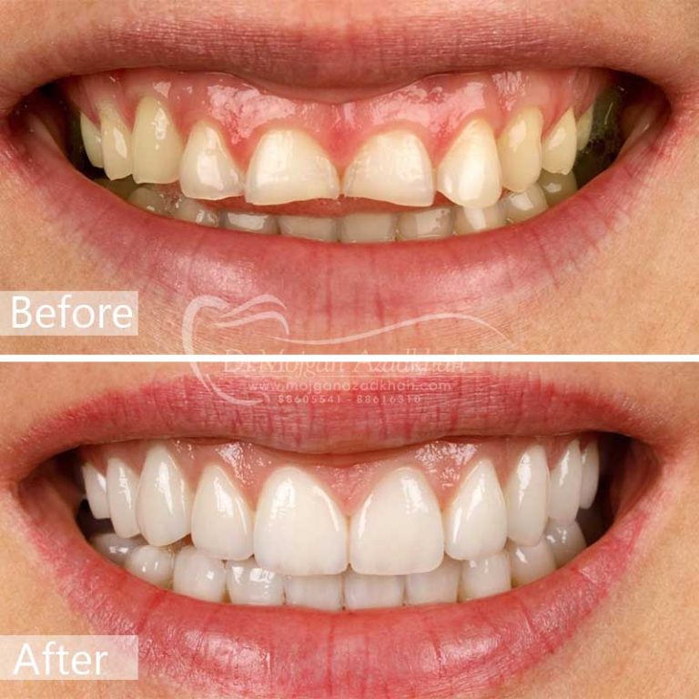 اصلاح لبخند لثه ای