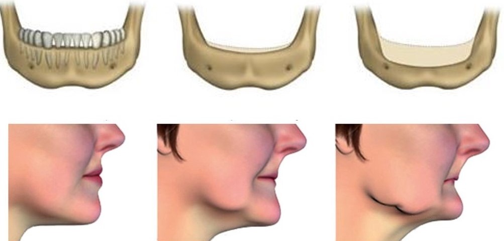 تحلیل استخوان فک