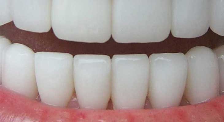 انواع لمینت دندان