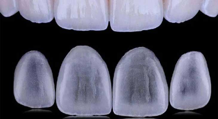 انواع لمینت دندان