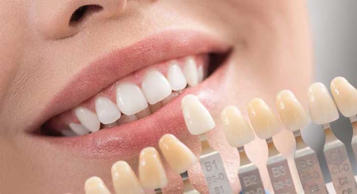 انواع لمینت دندان