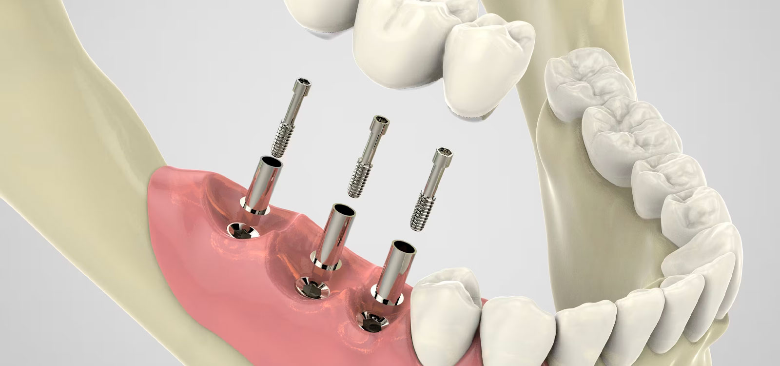 ایمپلنت پانچ