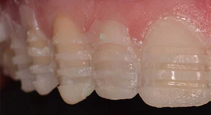 مقدار تراش دندان برای لمینت