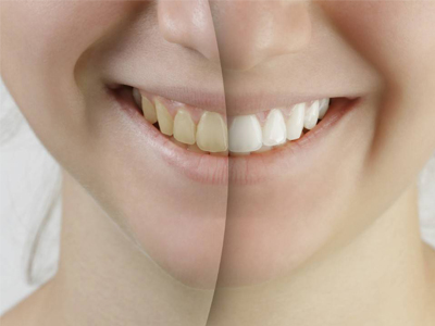 تغییر رنگ لمینت دندان