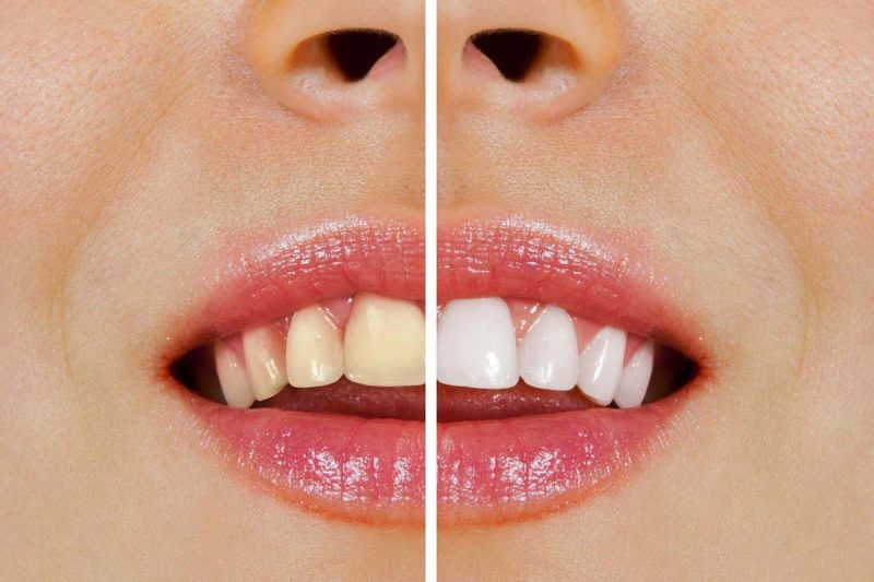 تغییر رنگ لمینت دندان