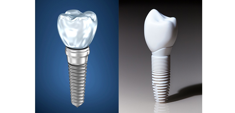 ایمپلنت سرامیکی دندان و ایمپلنت تیتانیومی