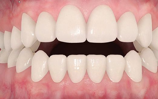 انواع بایت دندان: اپن بایت