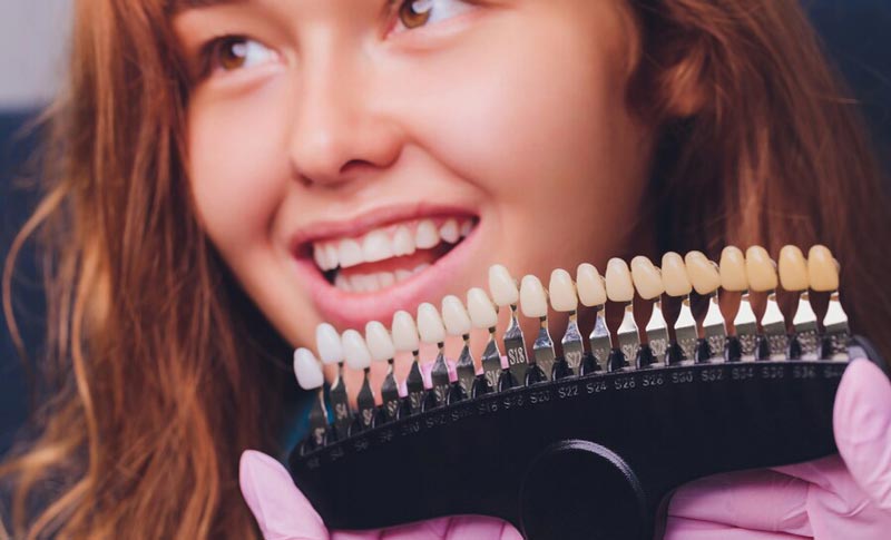 رنگ محبوب لمینت دندان