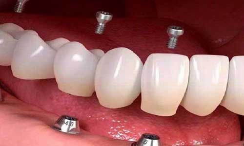 پروتز بر پایه ایمپلنت