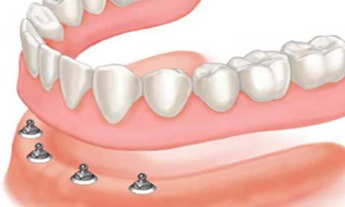 پروتز بر پایه ایمپلنت