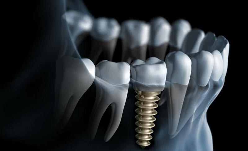 آیا ایمپلنت باعث سرطان می شود