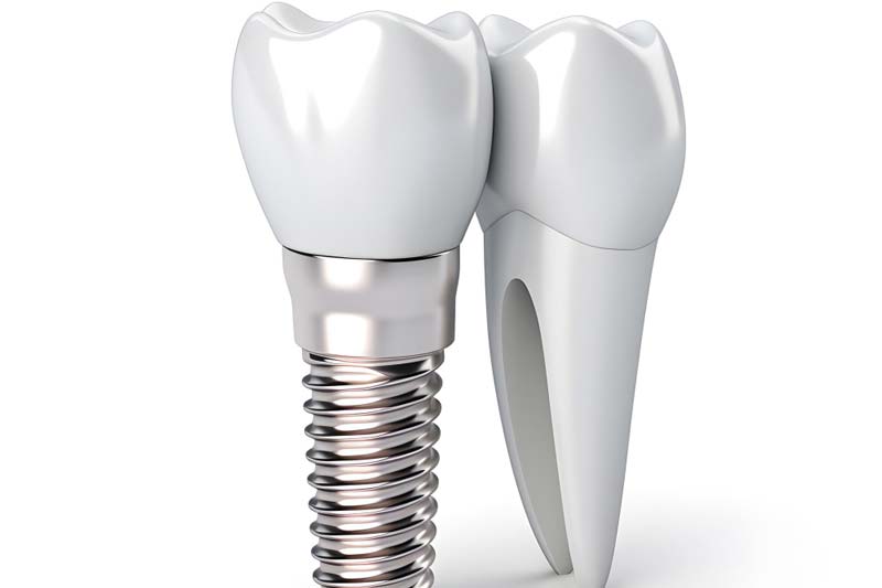 ایمپلنت کره ای دنتیس