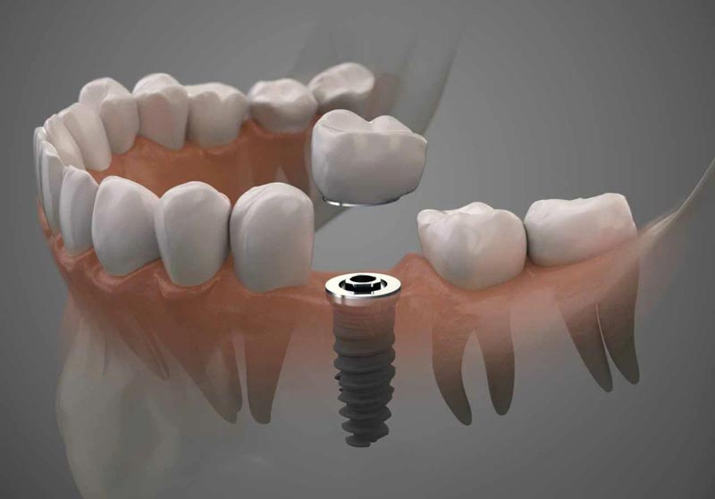 رابطه ایمپلنت و سرطان