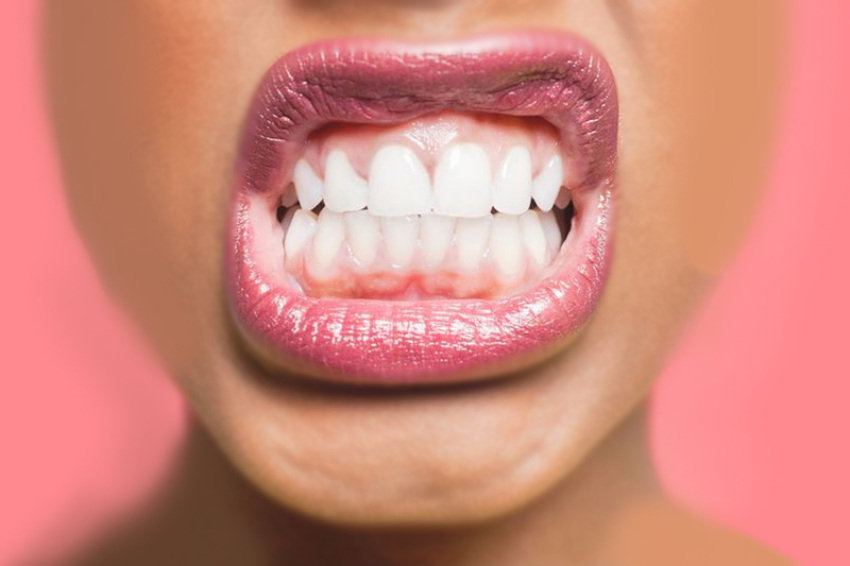 ایمپلنت دندان در افراد مبتلا به دندان قروچه