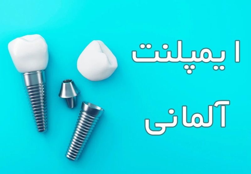 ایمپلنت آلمانی