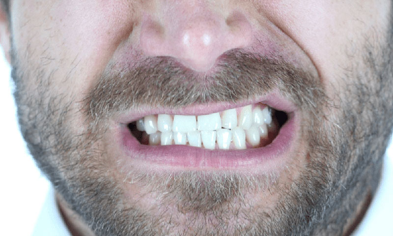 ایمپلنت دندان در افراد مبتلا به دندان قروچه