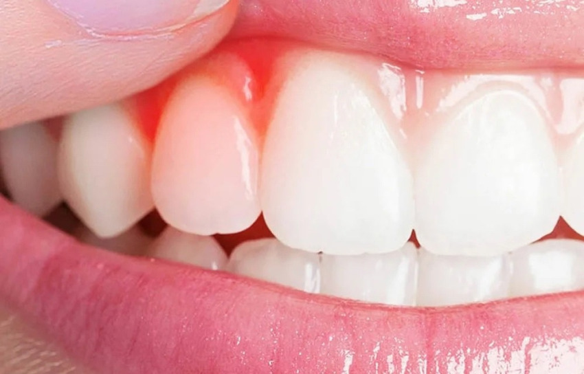 خونریزی لثه در بارداری